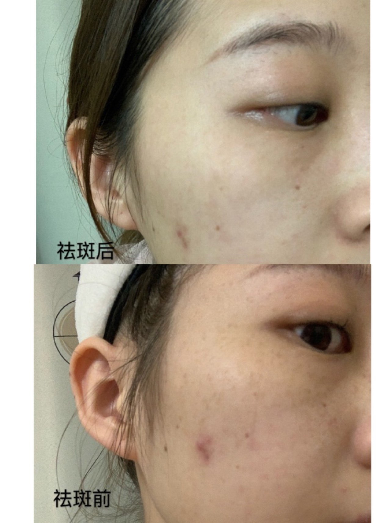 调q祛斑通过激光的选择性光热作用,靶向"击碎"皮肤_圈子-新氧美容整形