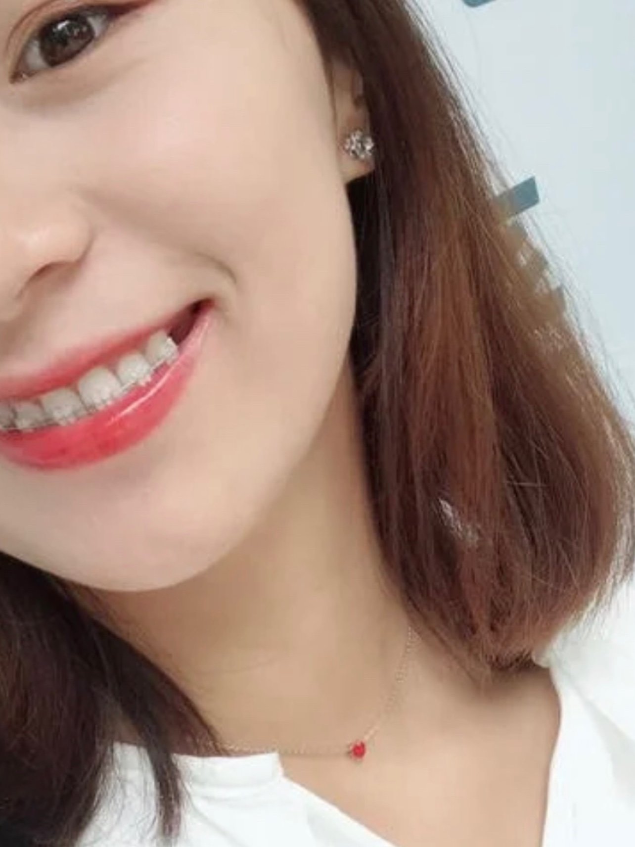 陶瓷半隐形矫正第11个月啦