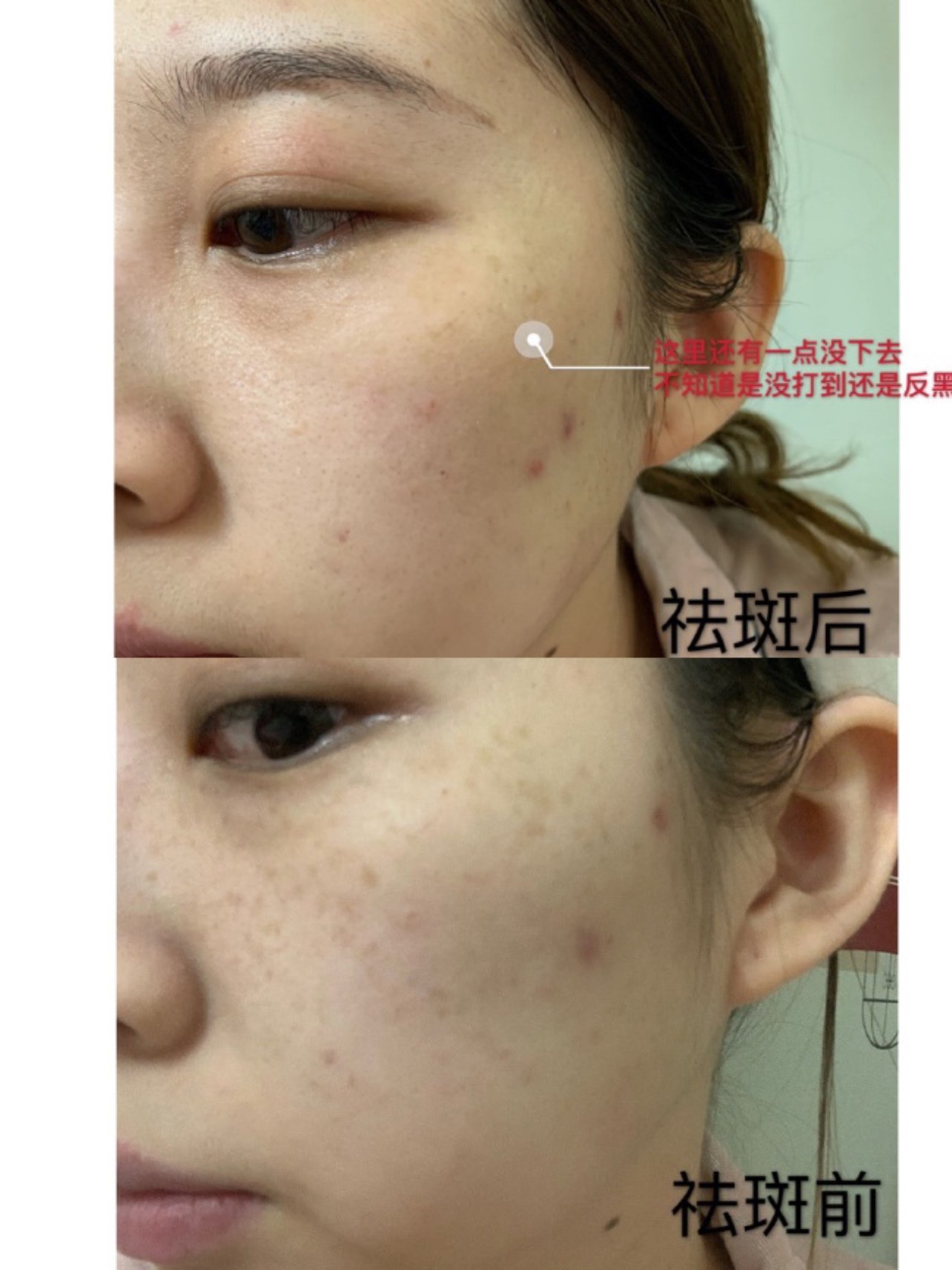 调q祛斑通过激光的选择性光热作用,靶向"击碎"皮肤_圈子-新氧美容整形