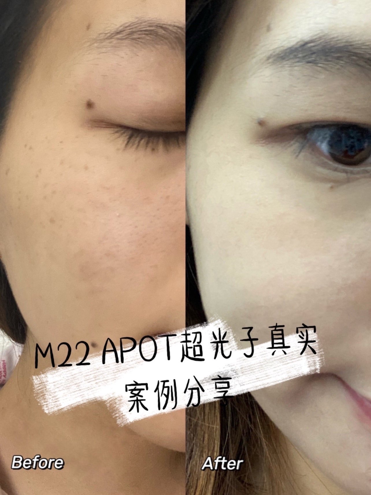 m22超光子嫩肤真实案例分享