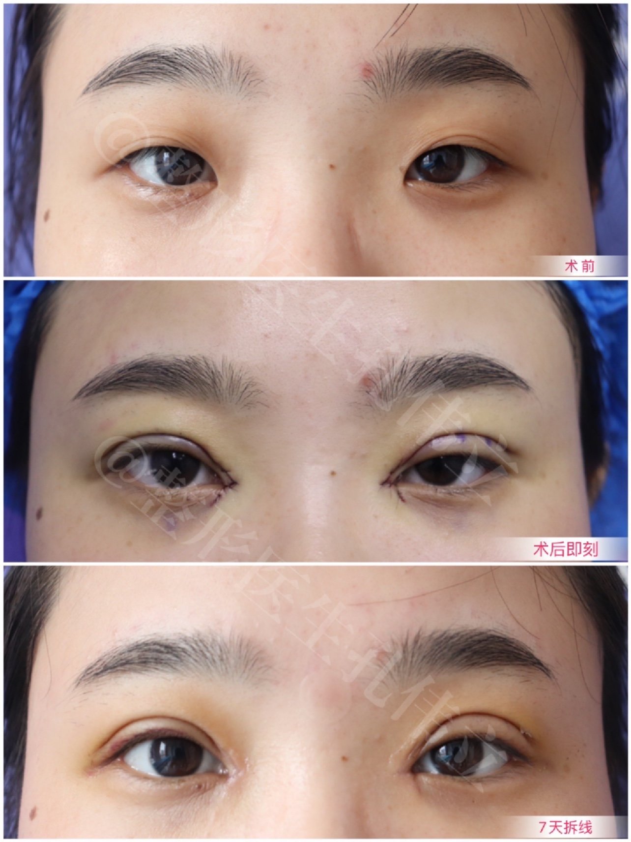 图1-21 老年性上眼睑松弛症和睑裂狭小-眼前节疾病-医学