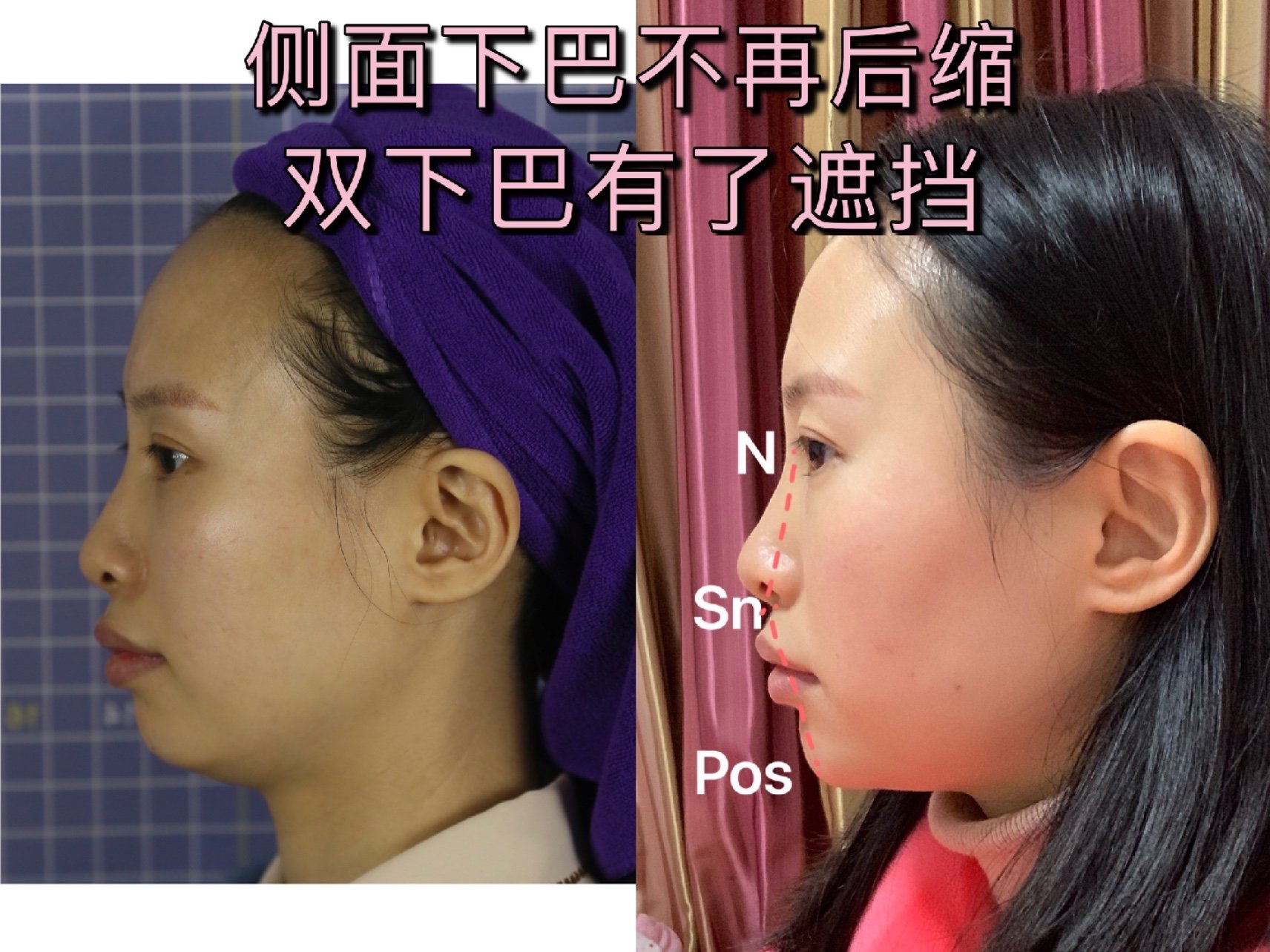 每每安慰自己,亚洲人的下巴就是这样微微后缩,显得娇憨可爱的嘛~然而