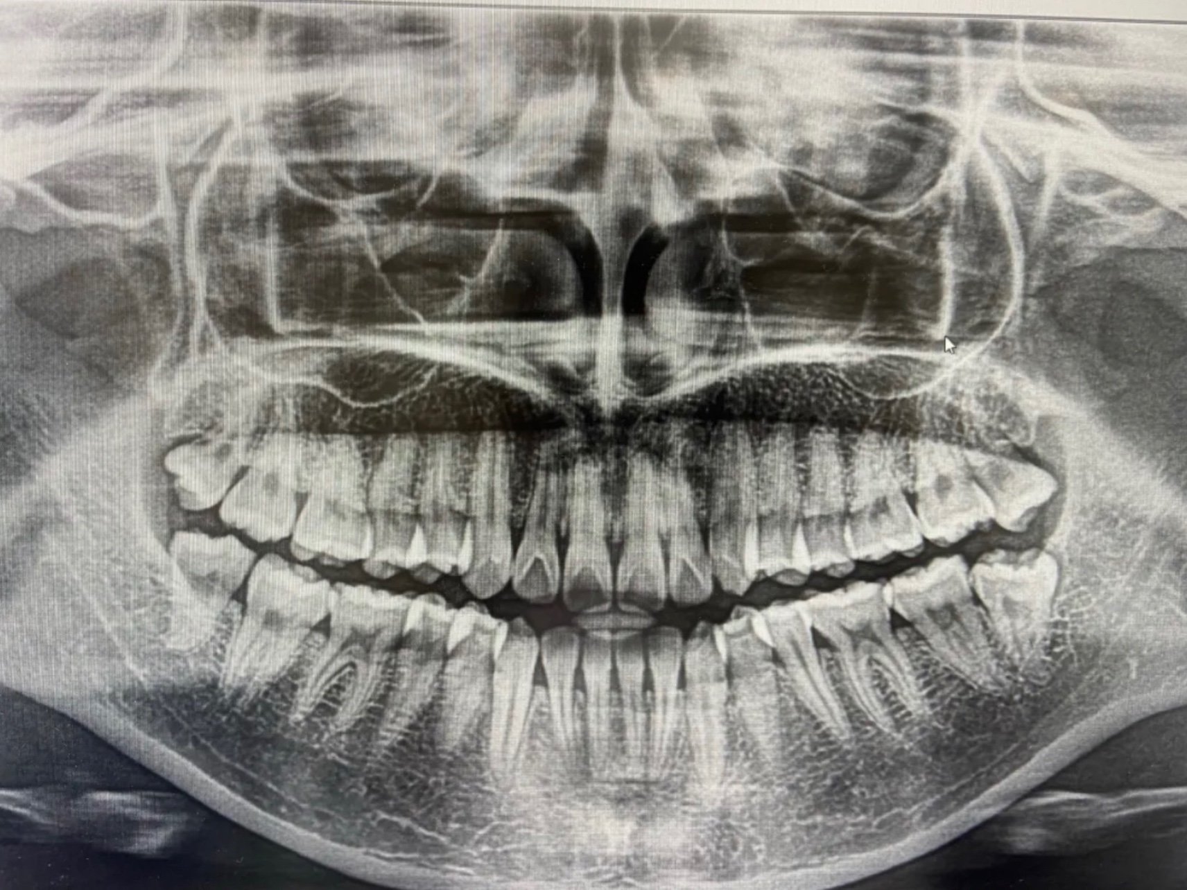【拔智齿】拔牙拔智齿 上颌/上牙简单智齿拔除 经验医师疼痛小出血少