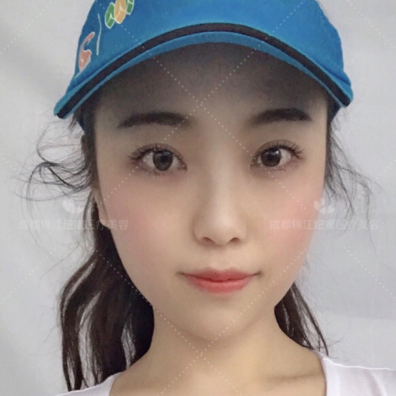 【术前诊断】:术前求美者双眼皮较窄,有内眦赘皮,眼_圈子-新氧美容