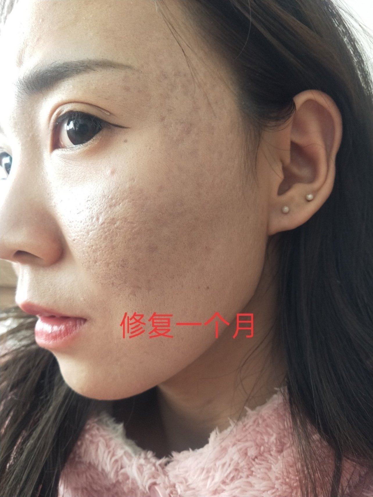 痘坑修复黄金微针一个月以后的效果