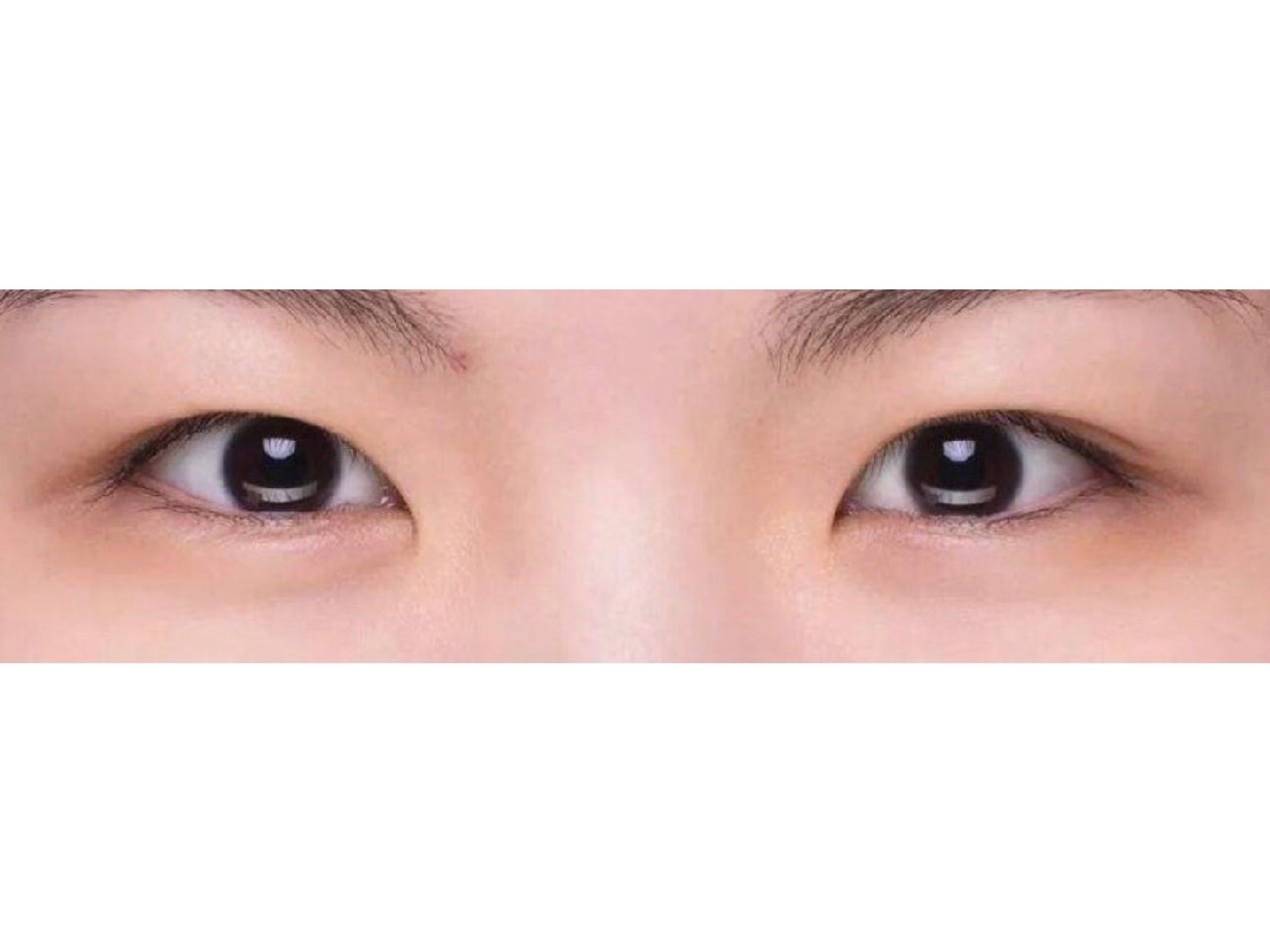 双眼皮什么情况下会变内双?