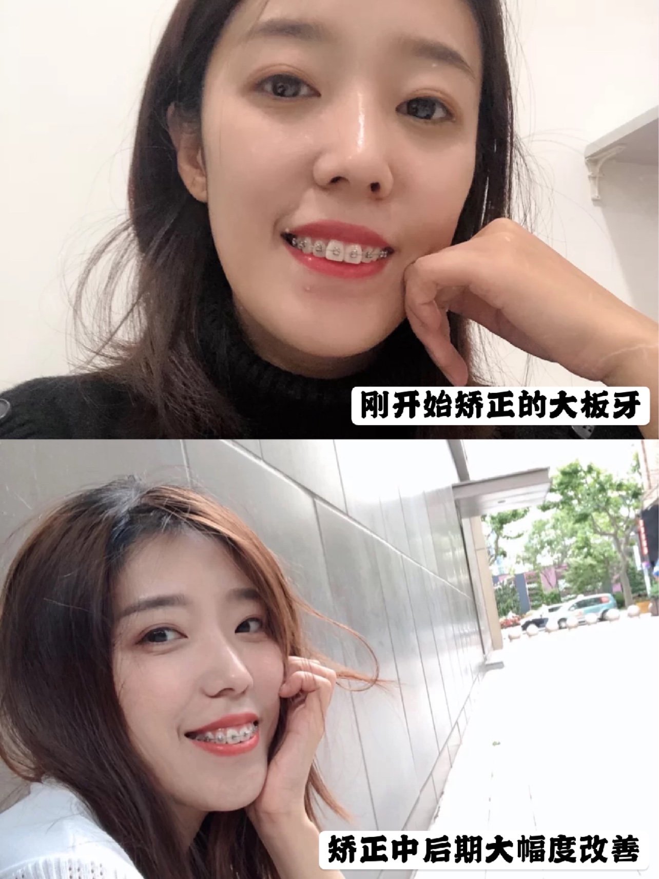 案例分析Ⅰ小姐姐大板牙调整后甜美出镜9199矫正地点:_圈子-新氧