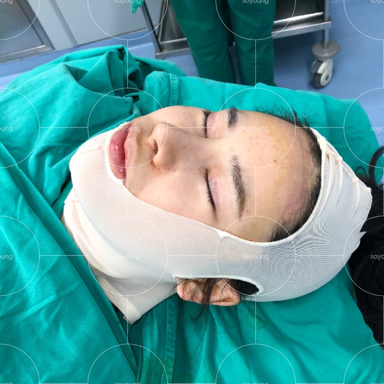 地包天下颏截骨术后即刻对比