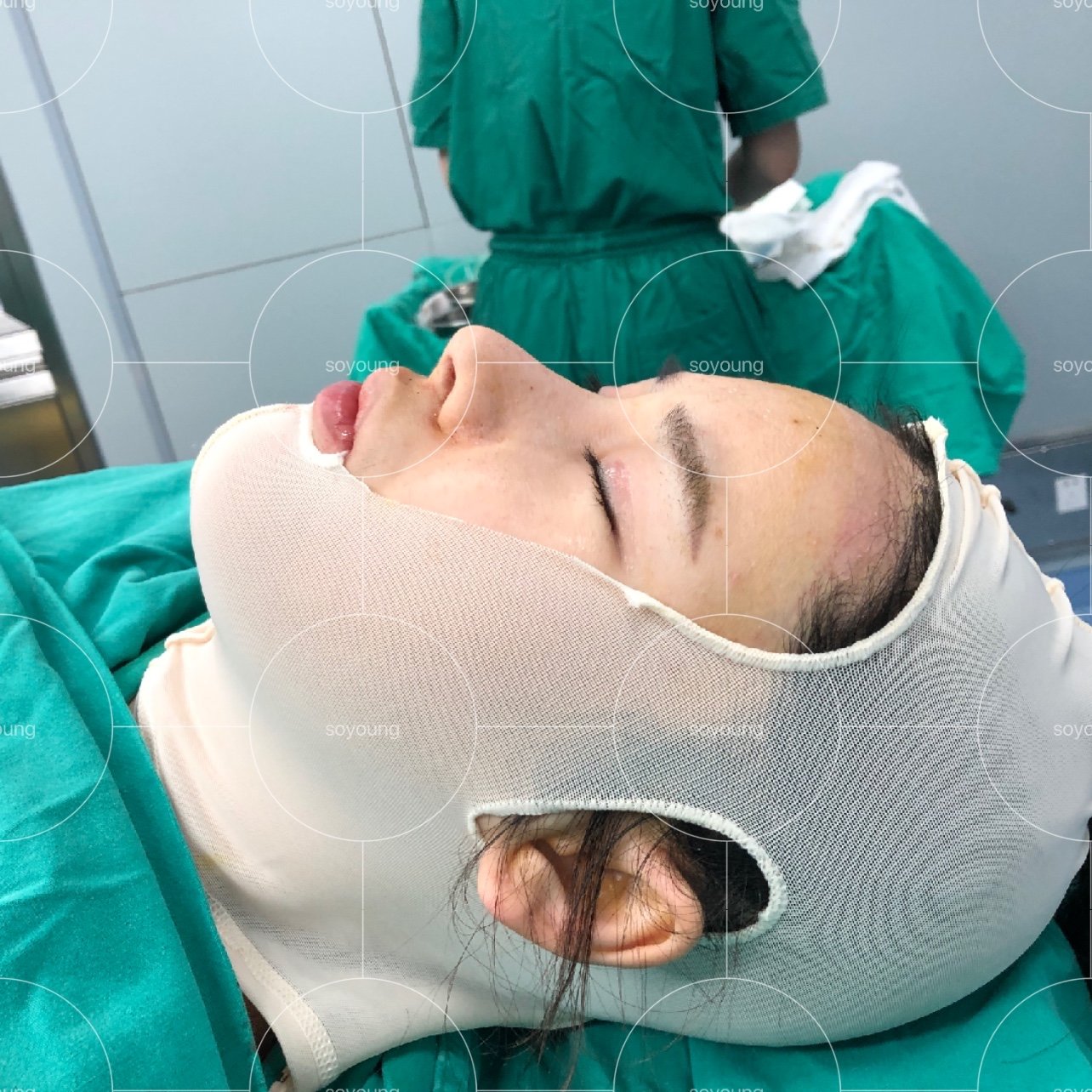 地包天下颏截骨术后即刻对比
