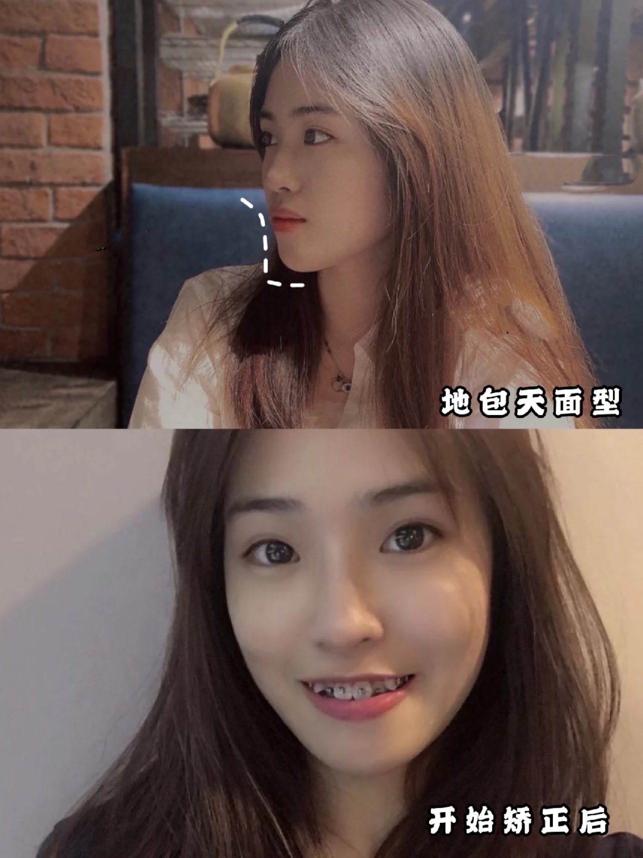 正畸让地包天小姐姐摆脱牙周病和凹瘪脸
