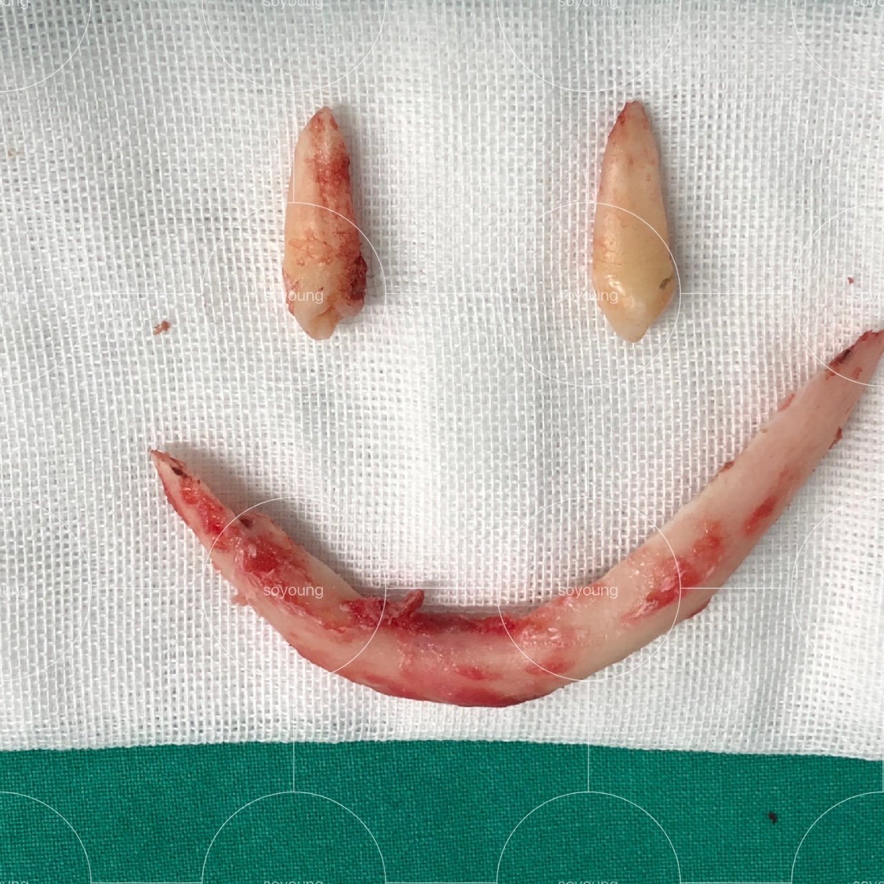 地包天下颏截骨术后即刻对比