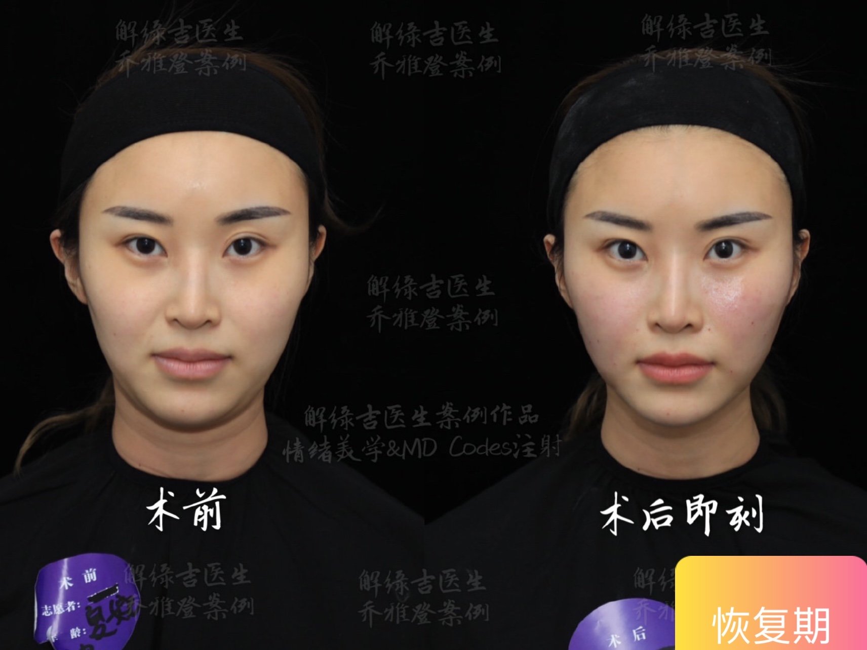 【乔雅登情绪美学mdcodes注射方案】颠覆传统医_圈子-新氧美容整形