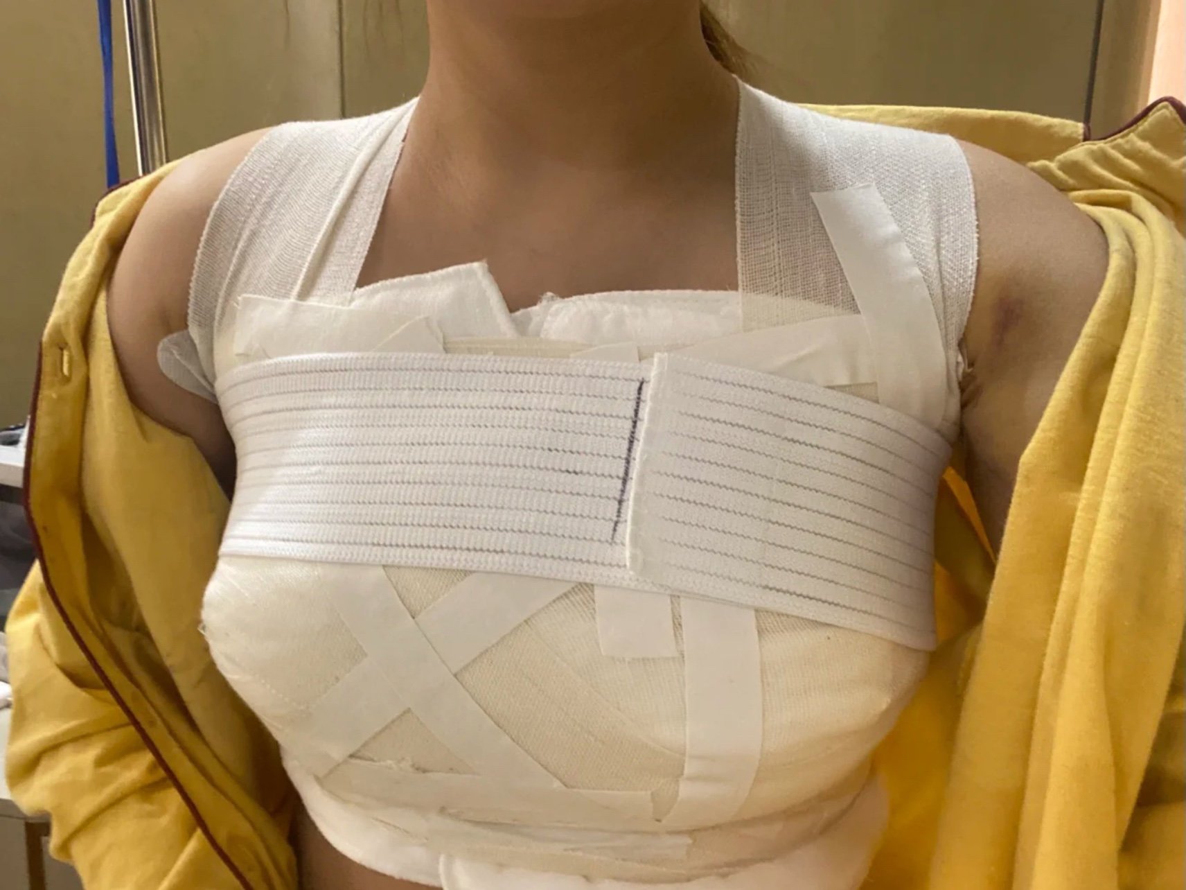 我终于去把我这么多年心心念念的隆胸手术给做了