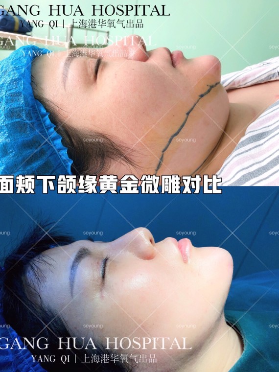 面颊下颌缘黄金微雕对比