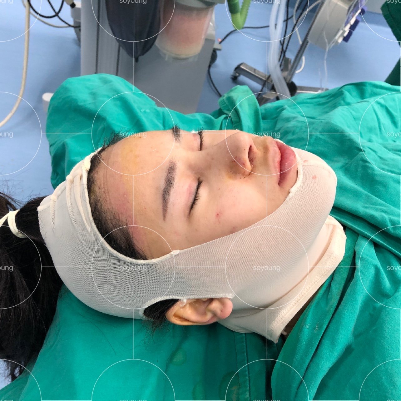 地包天下颏截骨术后即刻对比