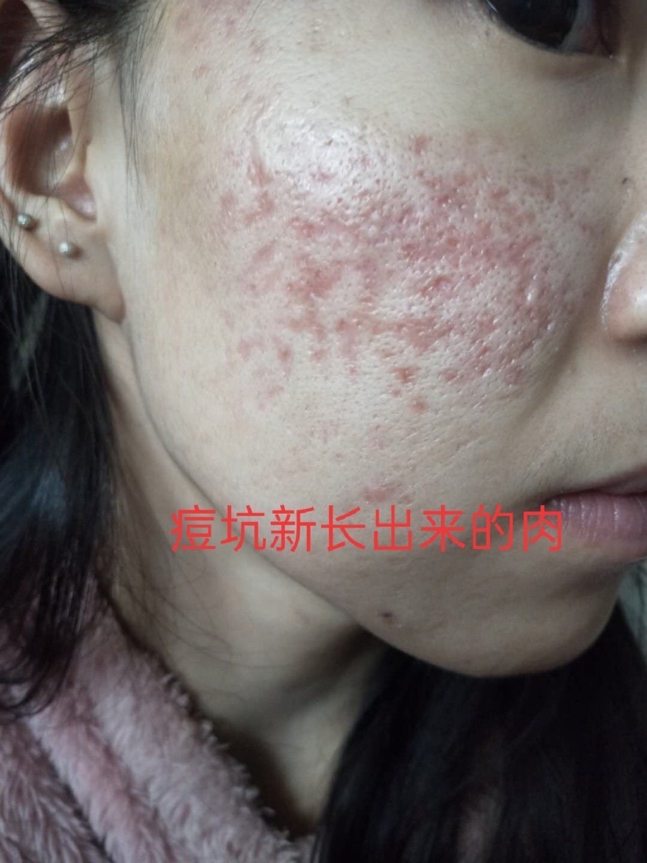 痘坑修复黄金微针一个月以后的效果