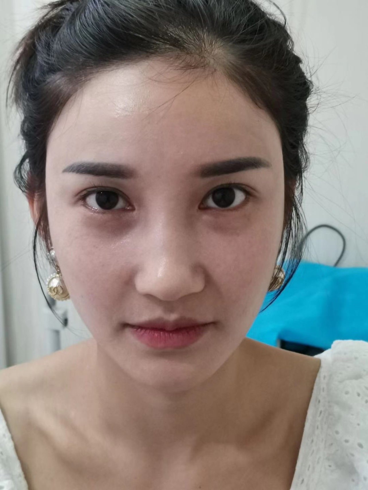 终于来做玻尿酸丰眉弓了!