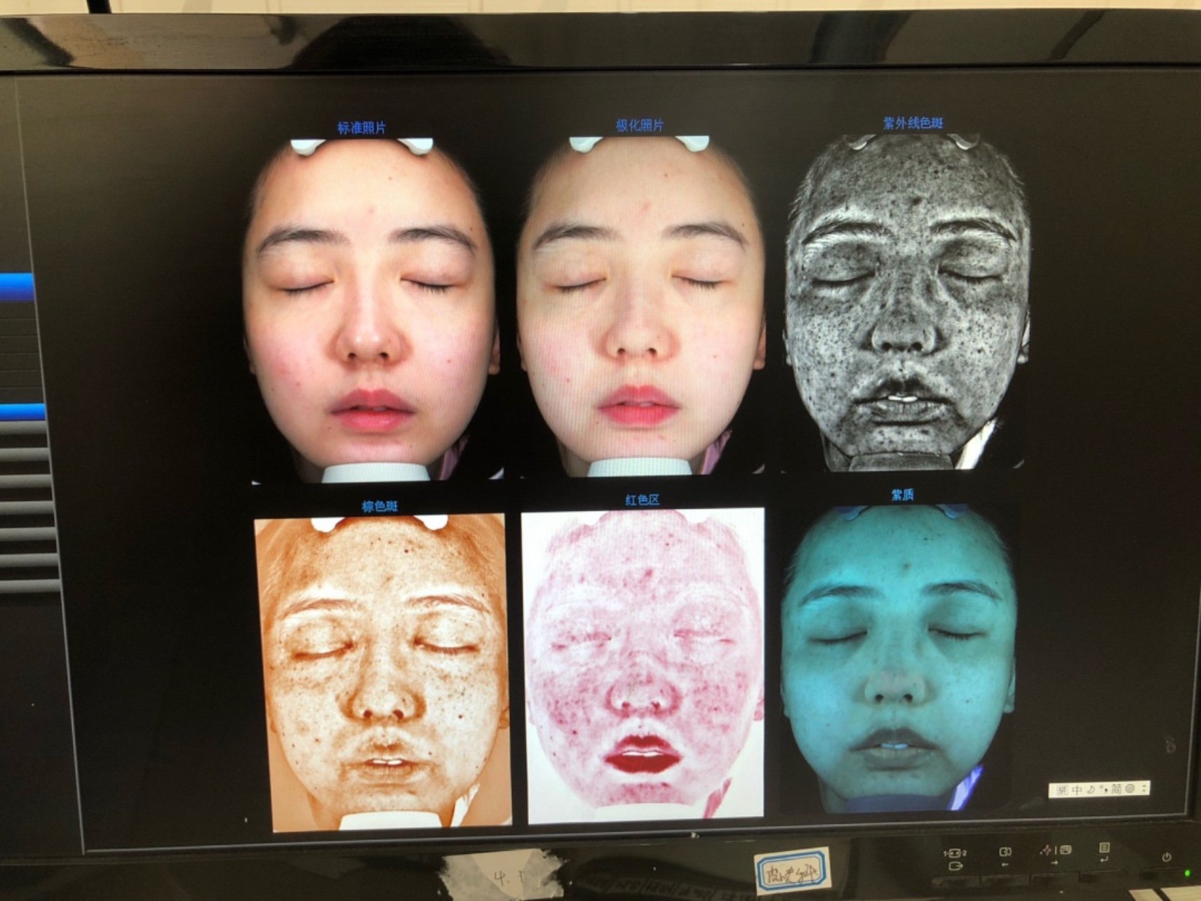 玫瑰痤疮轻度第一次打光子嫩肤