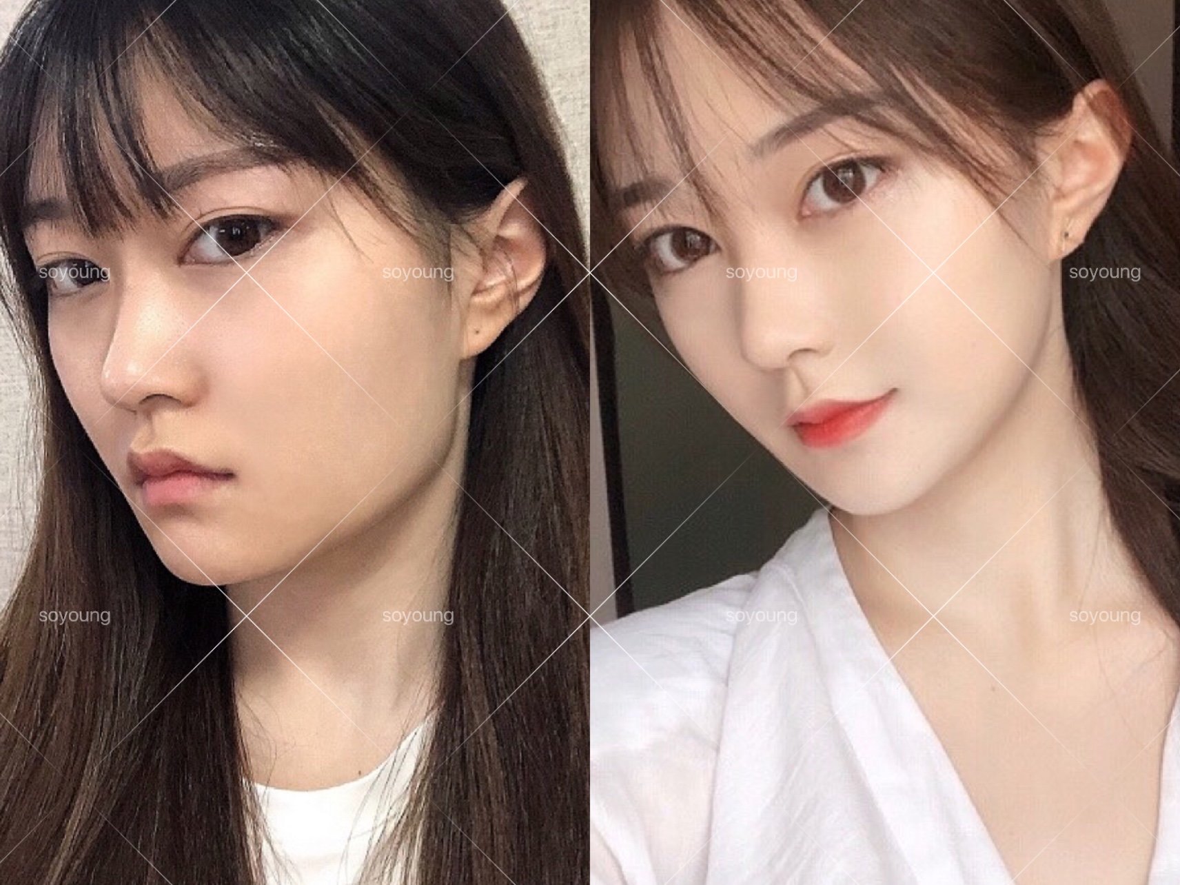 适合咬肌肥大,瘦脸针多次注射无效的 做下颌角时可以一步到位永久去除