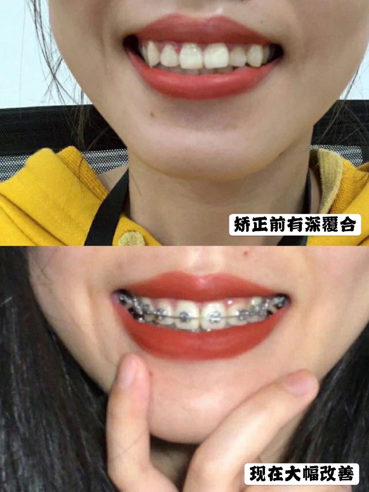 为大家介绍的是一位牙性龅牙的小姐姐,嘴部受牙齿影响外凸症状较深