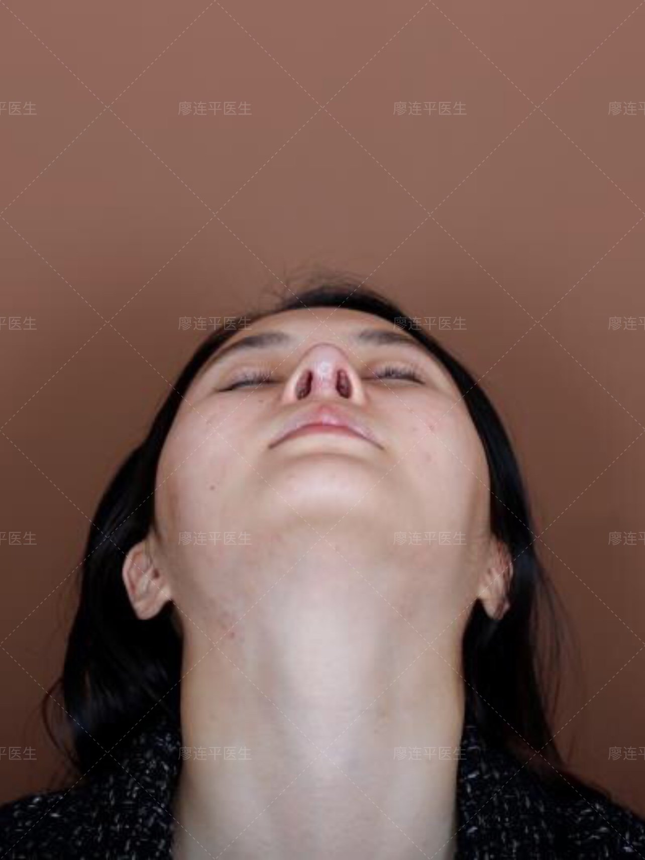 【术前诊断】:顾客之前做过三次鼻整形,最后一次做的_圈子-新氧美容