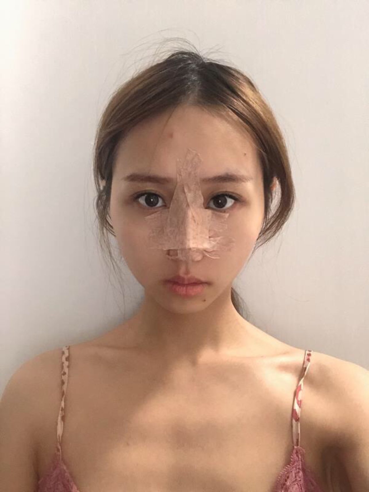 现在就给大家分享一个鼻子案例 术前分析:,鼻基底凹陷,鼻头较肥大