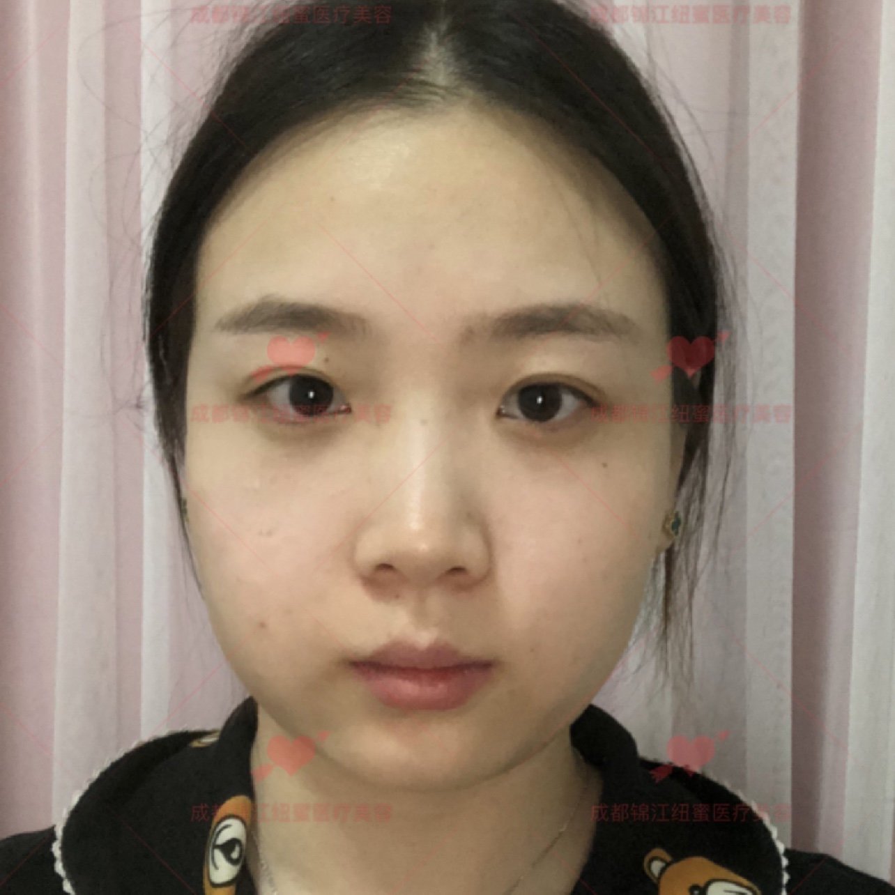 求美者面颊脂肪堆积,下颌缘轮廓线不清晰,嘴角两侧脂肪堆积,导致面部