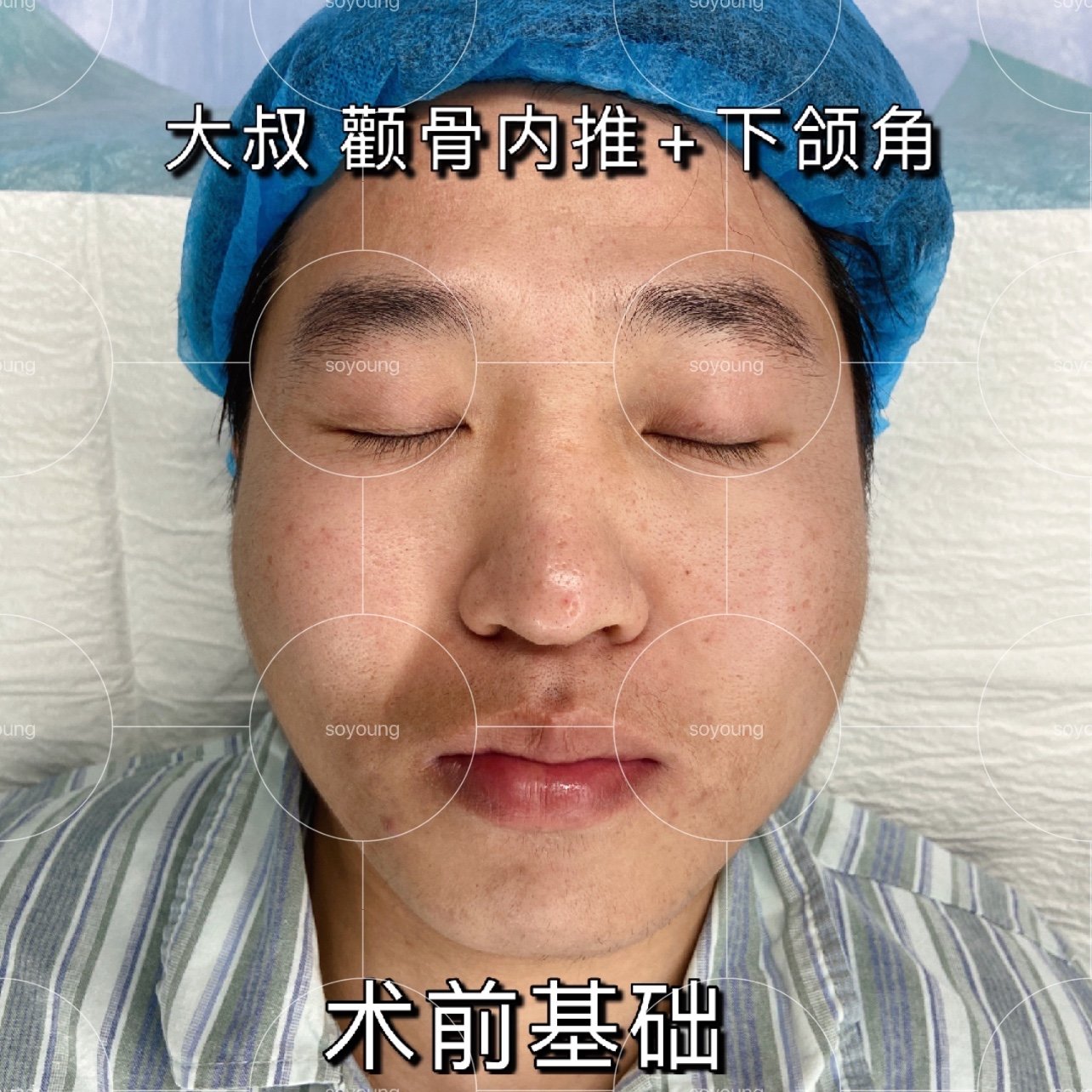 大叔颧骨内推下颌角长曲线术后即刻对比