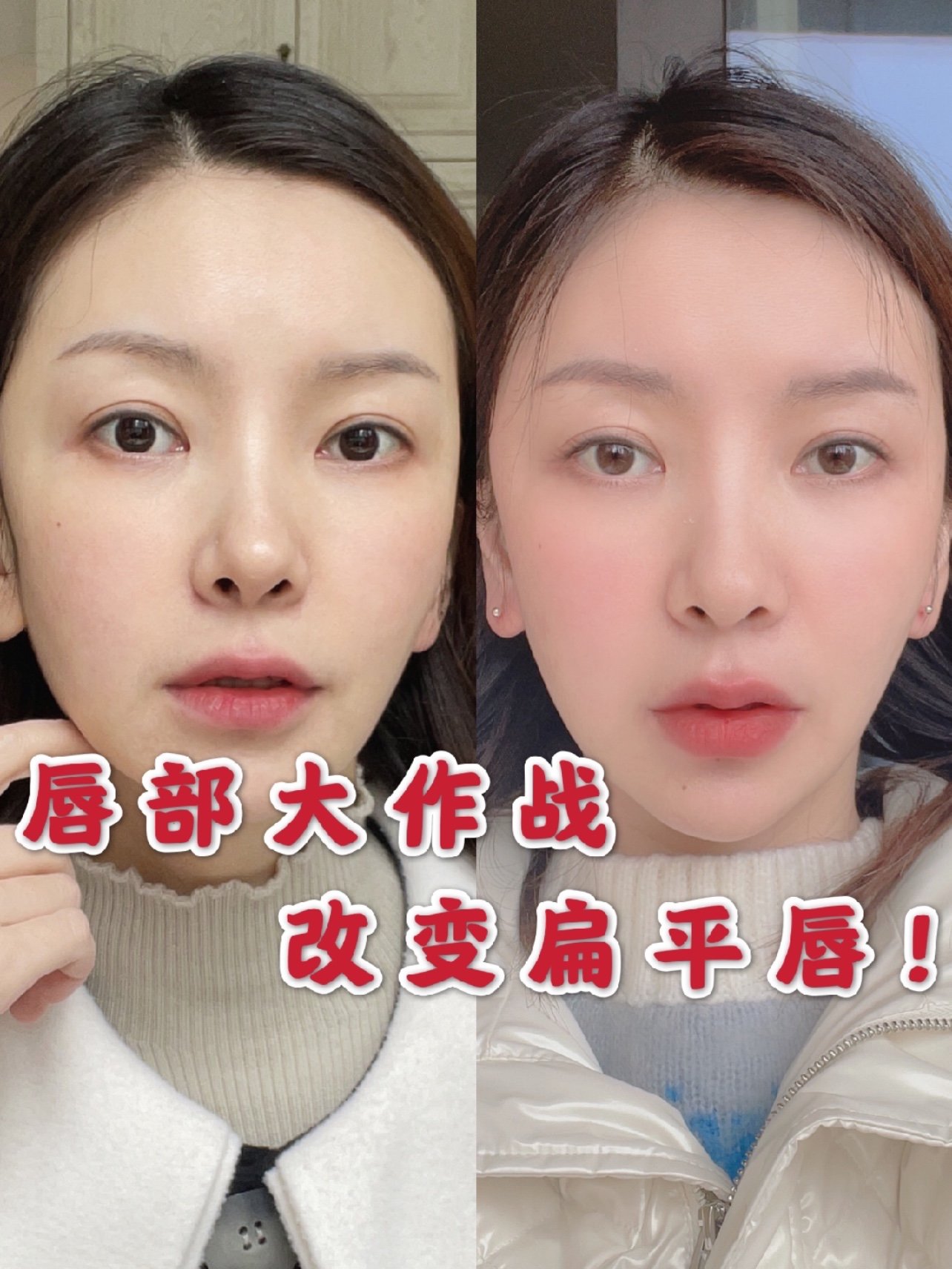我注射的部位有:上下唇 唇珠 人中脊 嘴角 选择是娇兰的玻尿酸,是