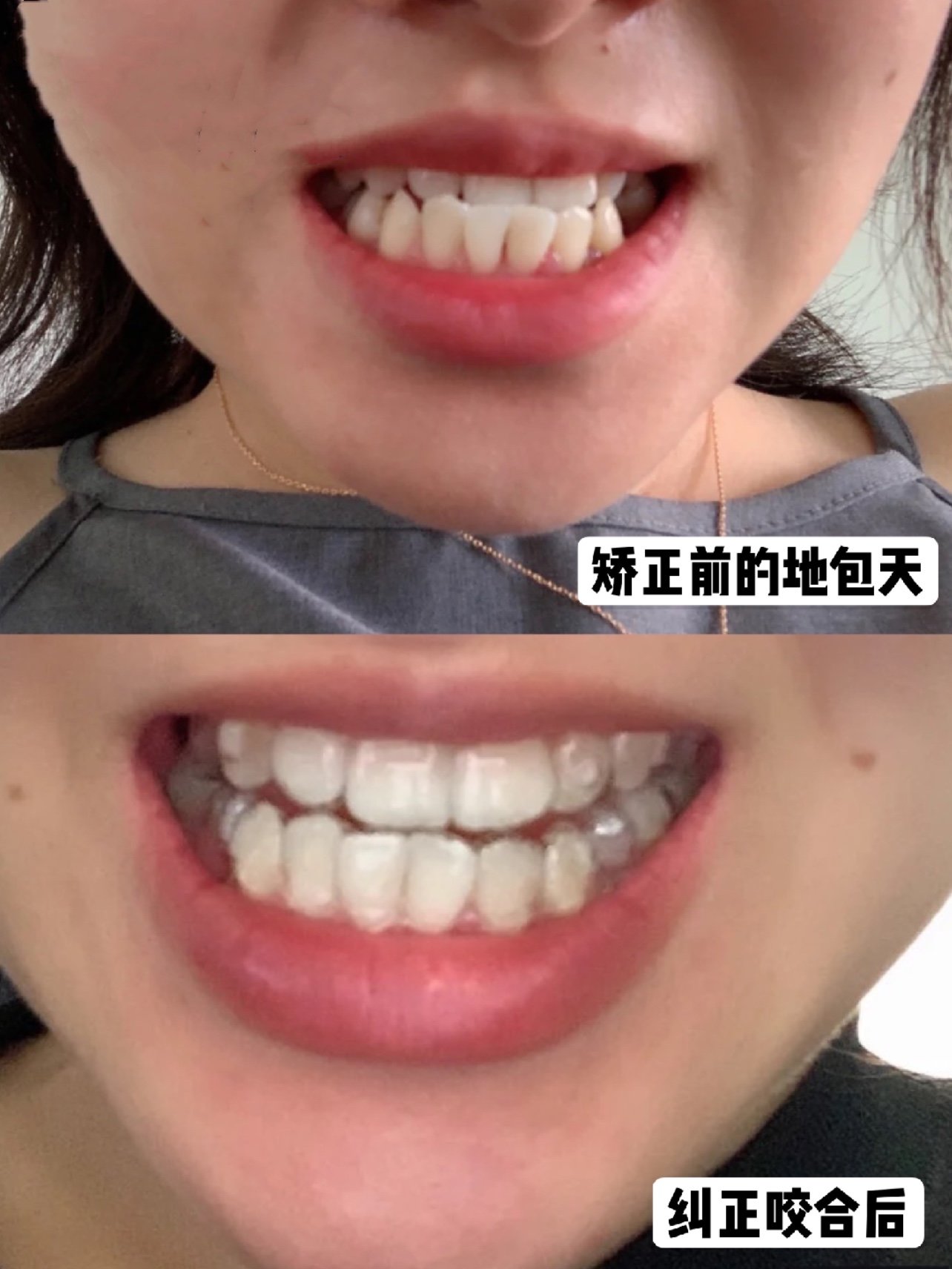 鞋拔脸不用怕,看看地包天小姐姐的正畸改变
