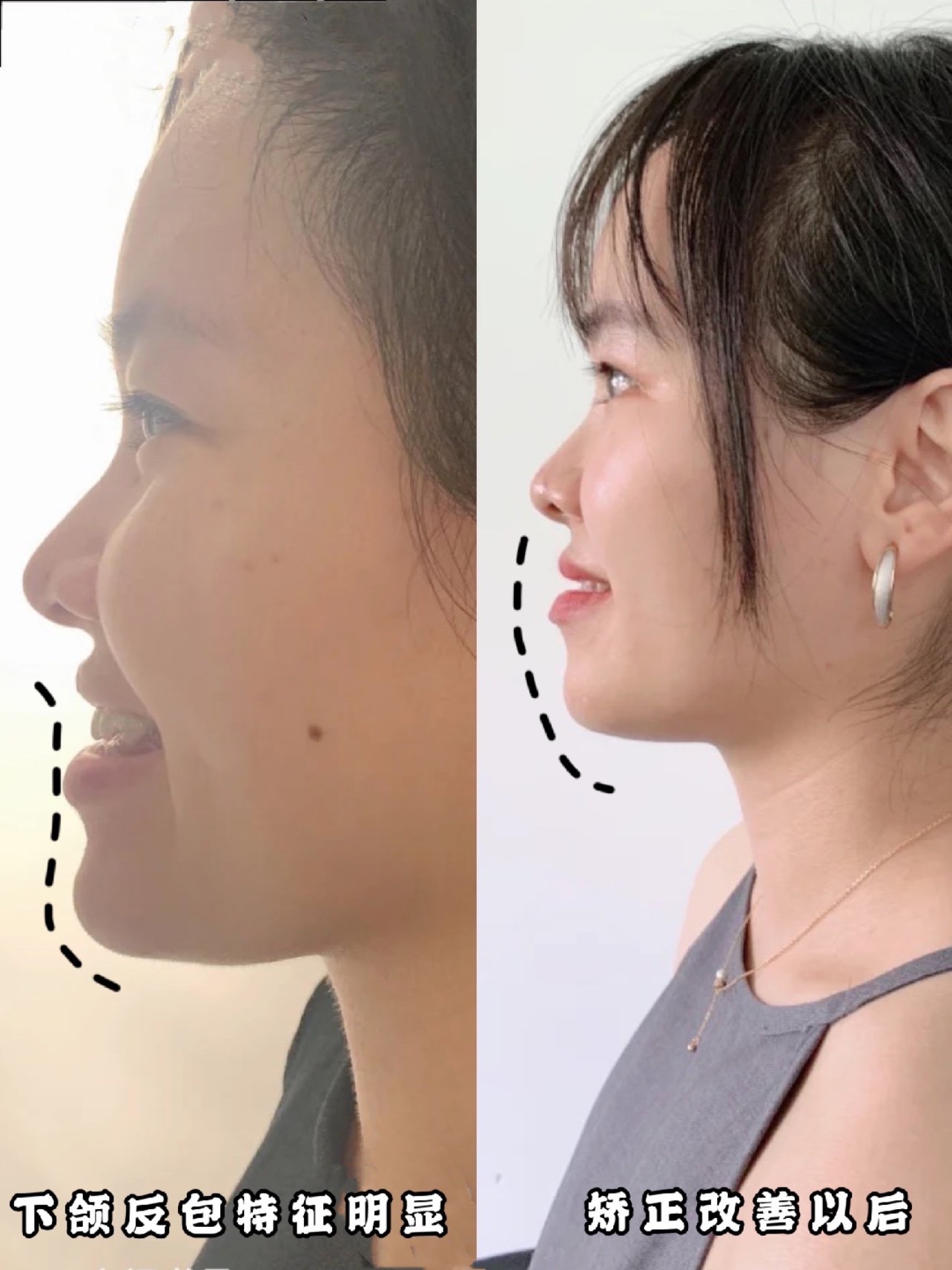 鞋拔脸不用怕,看看地包天小姐姐的正畸改变