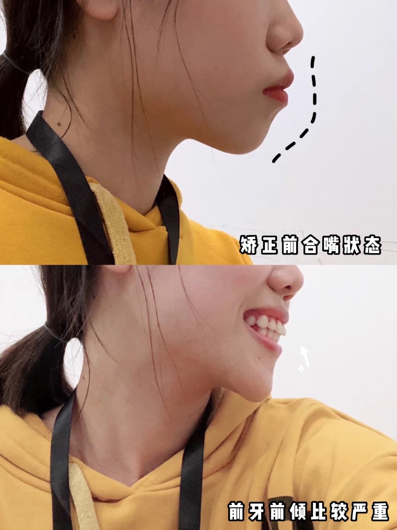 解决龅牙后这个侧颜美呆了