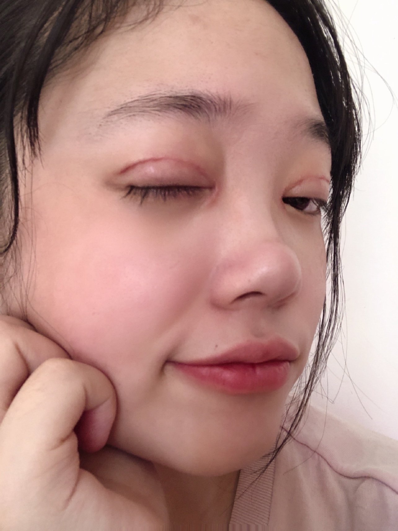 做完双眼皮已经一周了,刚拆完线的感觉真的太舒服了,_圈子-新氧美容