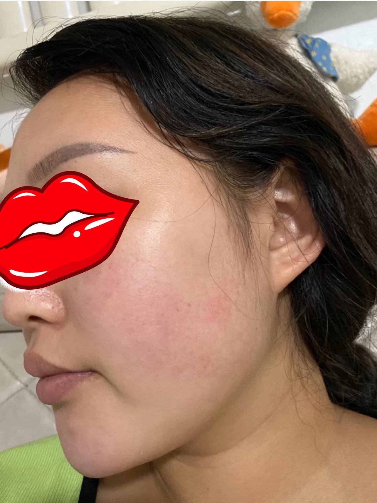 角质层薄,有红血丝,时不时过敏刺痒,空调吹了更难受_圈子-新氧美容