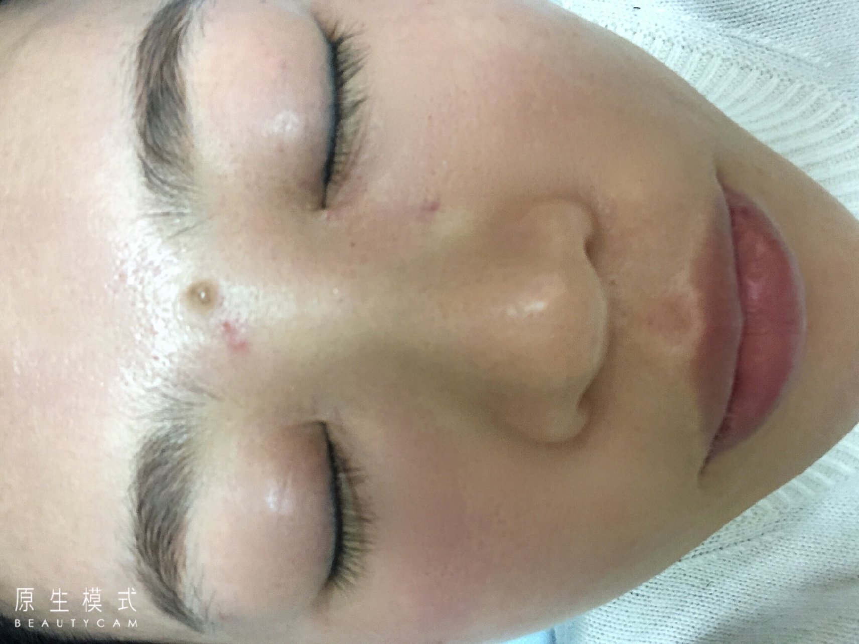 今天第三天黄金微针了红肿基本没有了还有点小针眼感觉项目性价比还是