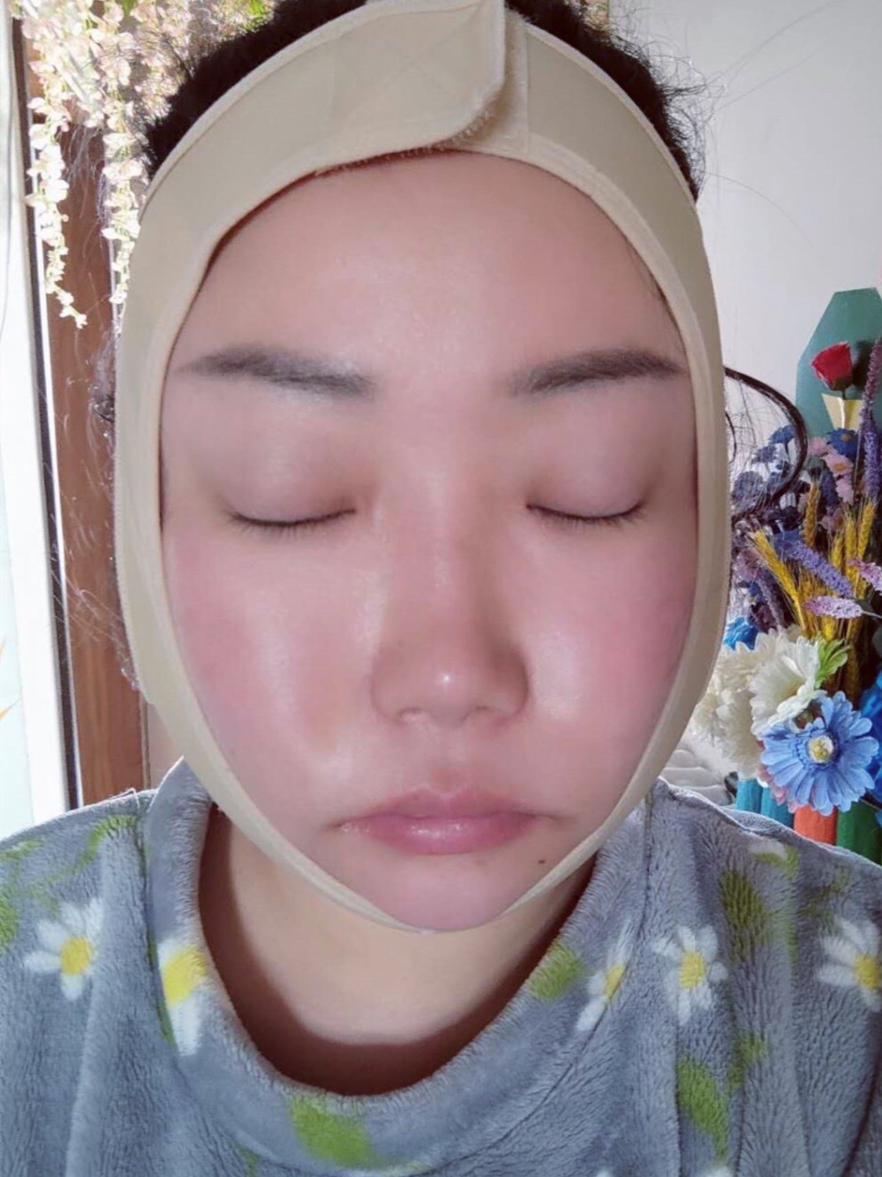 青岛华颜美钻石精雕面部吸脂术后2天
