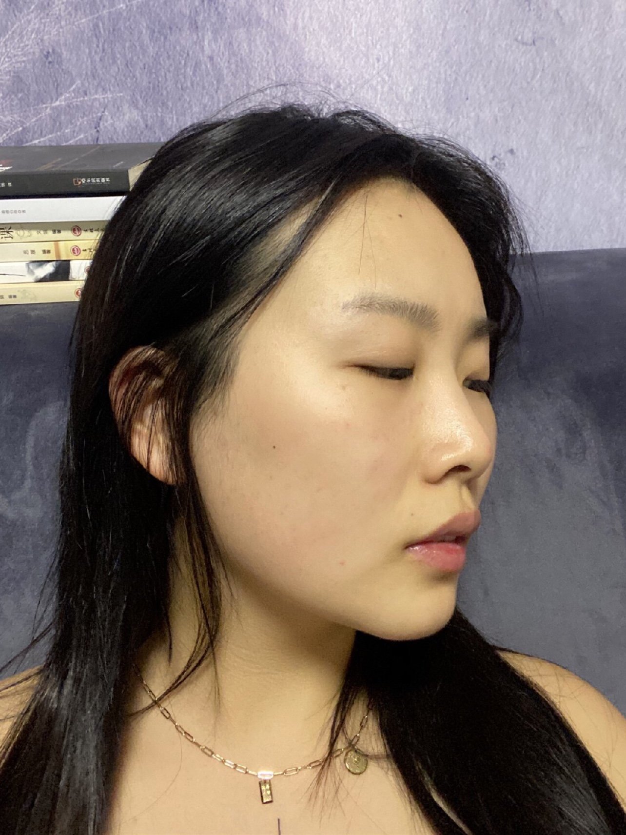 【青岛华颜美-中下面部线雕提升术术后第15天】