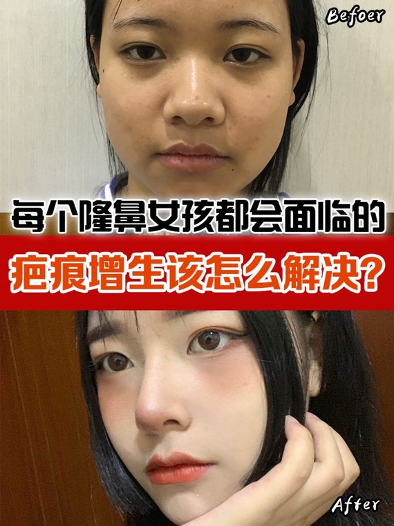 隆鼻女孩都会面临的疤痕增生该怎么解决
