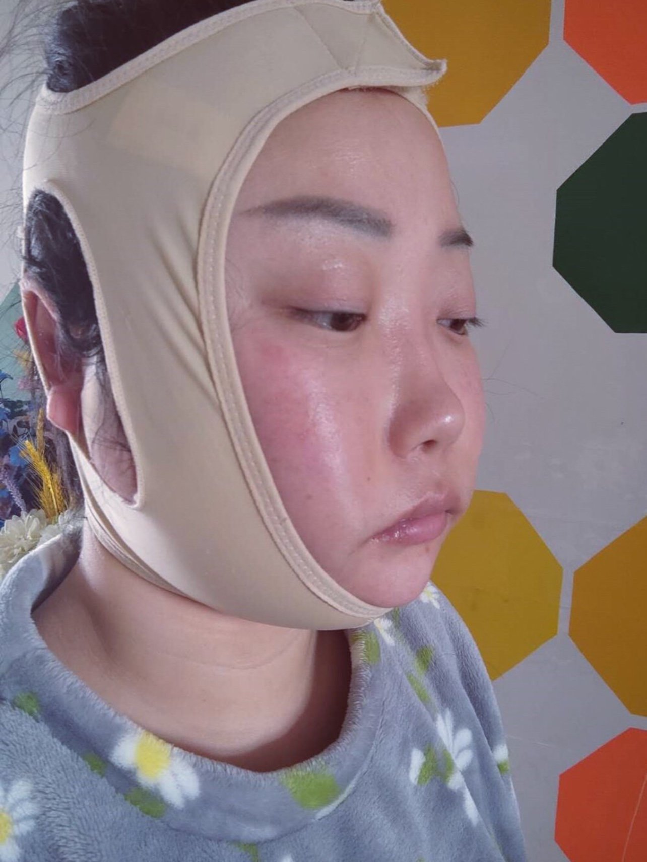 青岛华颜美钻石精雕面部吸脂术后2天