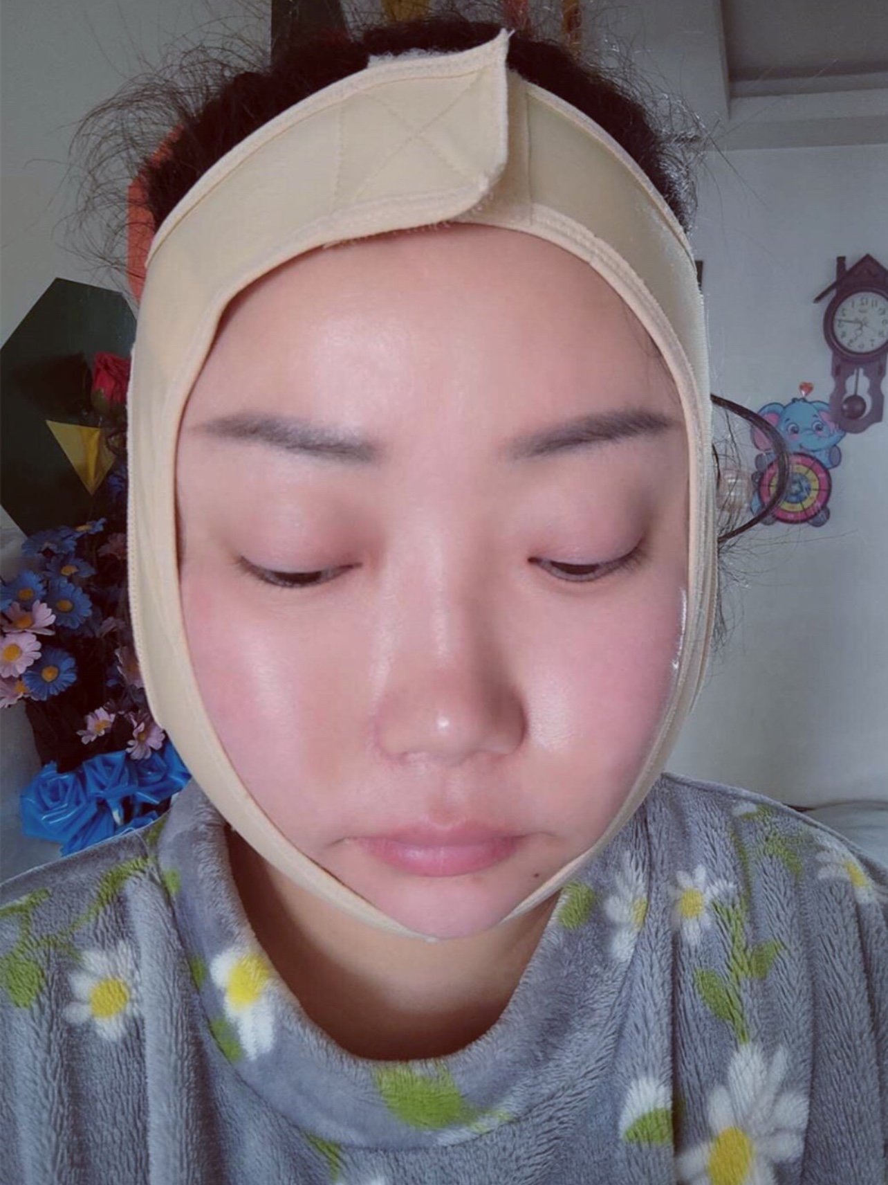 青岛华颜美钻石精雕面部吸脂术后2天