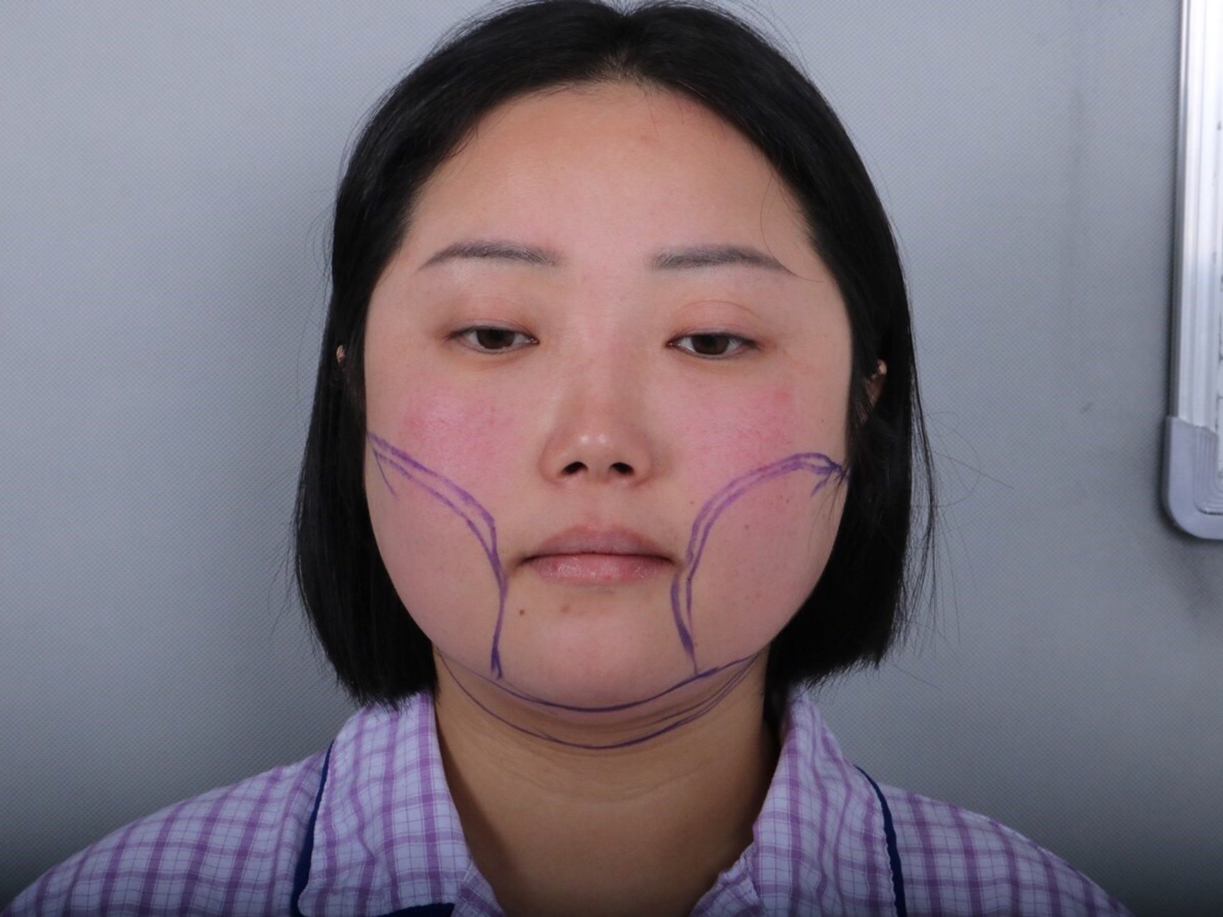 青岛华颜美钻石精雕面部吸脂术前