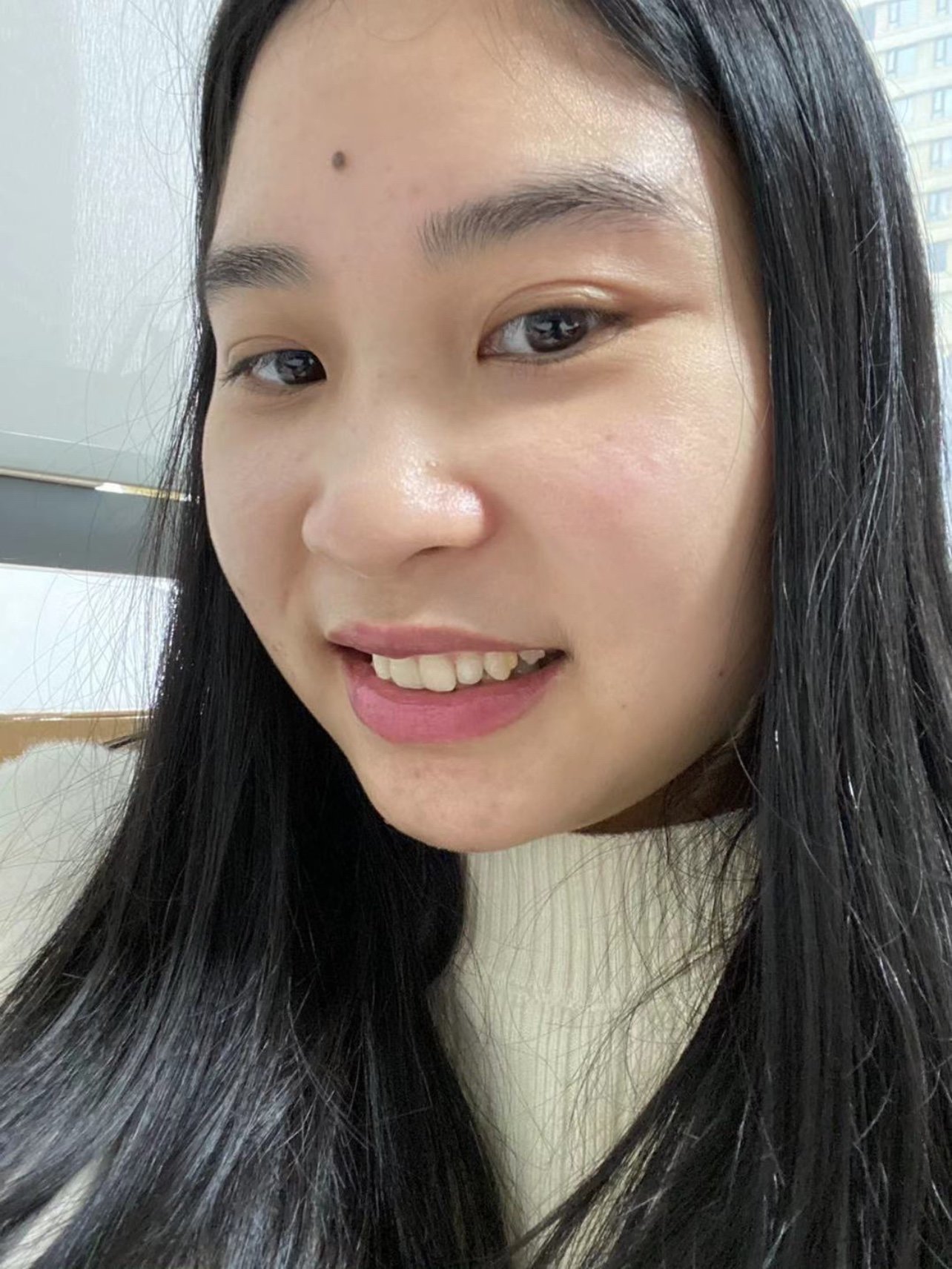 我是内倾型深覆合,有一颗牙齿长在里面的,每次笑起来_圈子-新氧美容