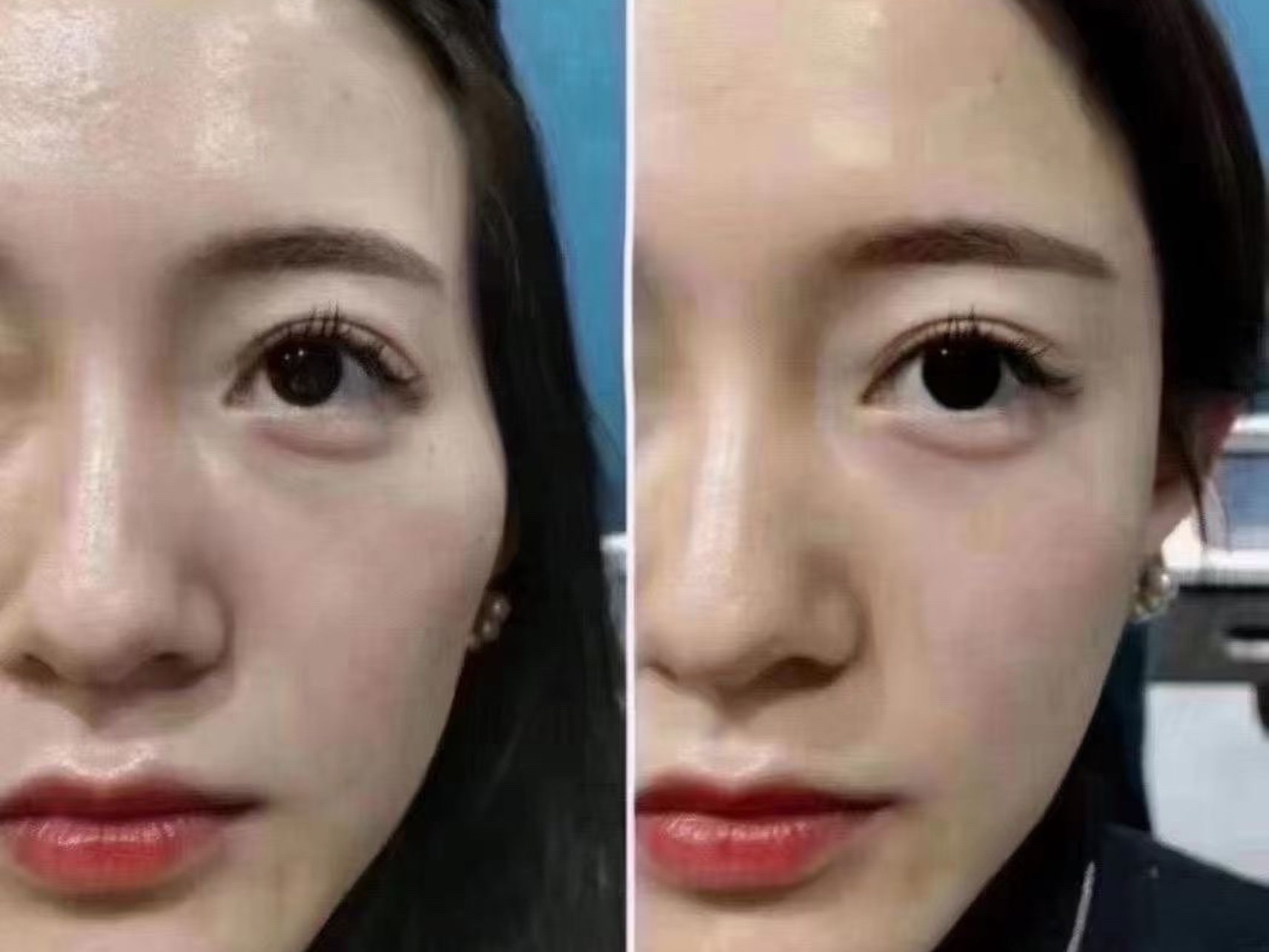 99太阳穴填充9599太阳穴凹陷导致少女感流失99颧骨高耸_圈子