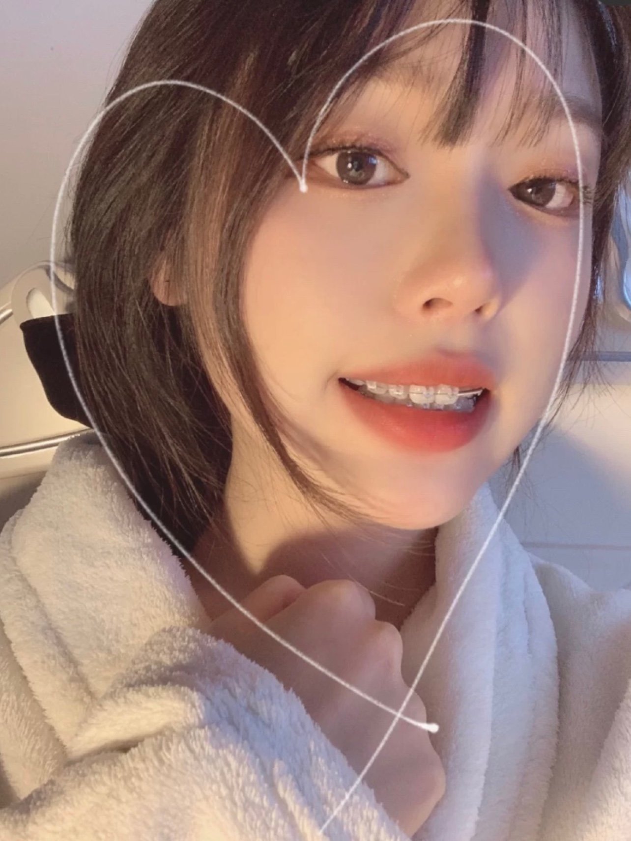 分享一只钢牙妹(^з^)大门牙已经全掰回来了,感觉_圈子-新氧美容整形