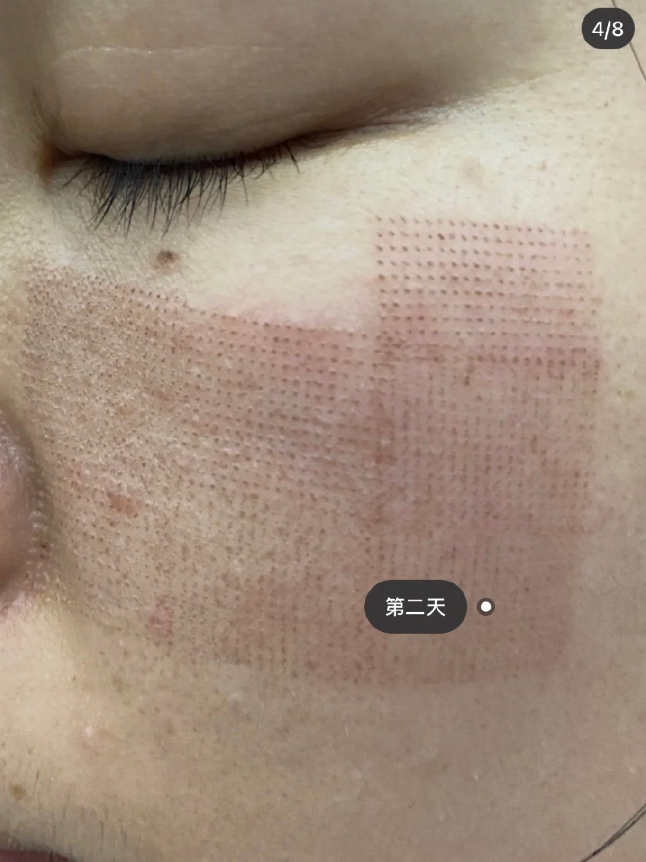 点阵收缩毛孔分享