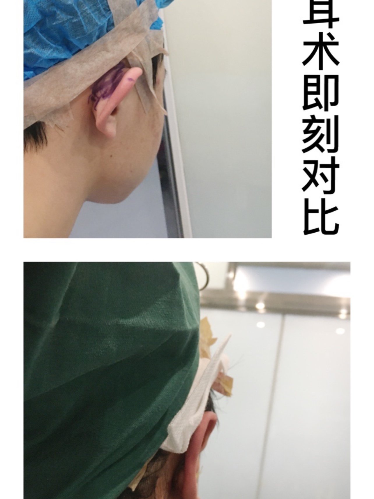 矫正耳廓外形,达到顾客满意后进行缝合,用庆大霉素冲洗后加压包扎