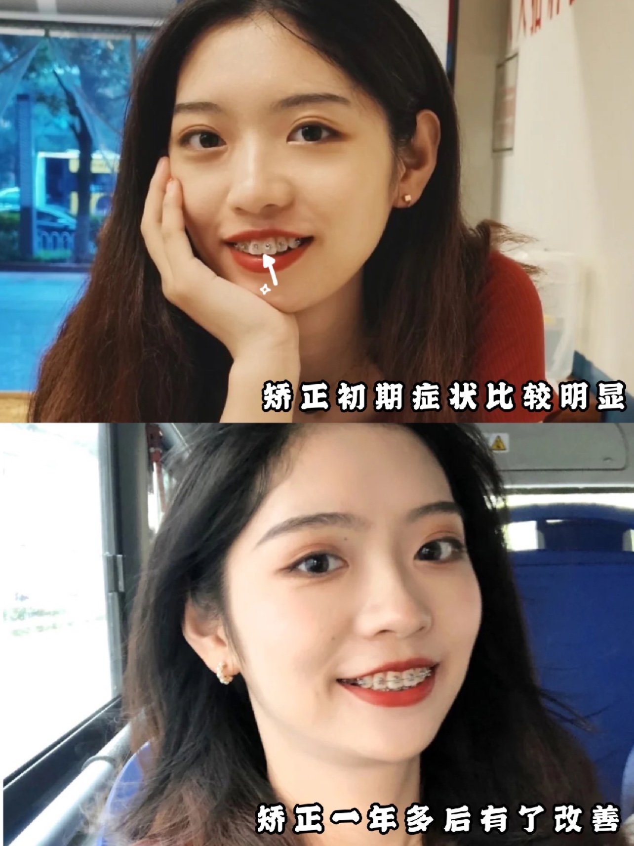 整牙案例Ⅰ大门牙女生的一路逆袭