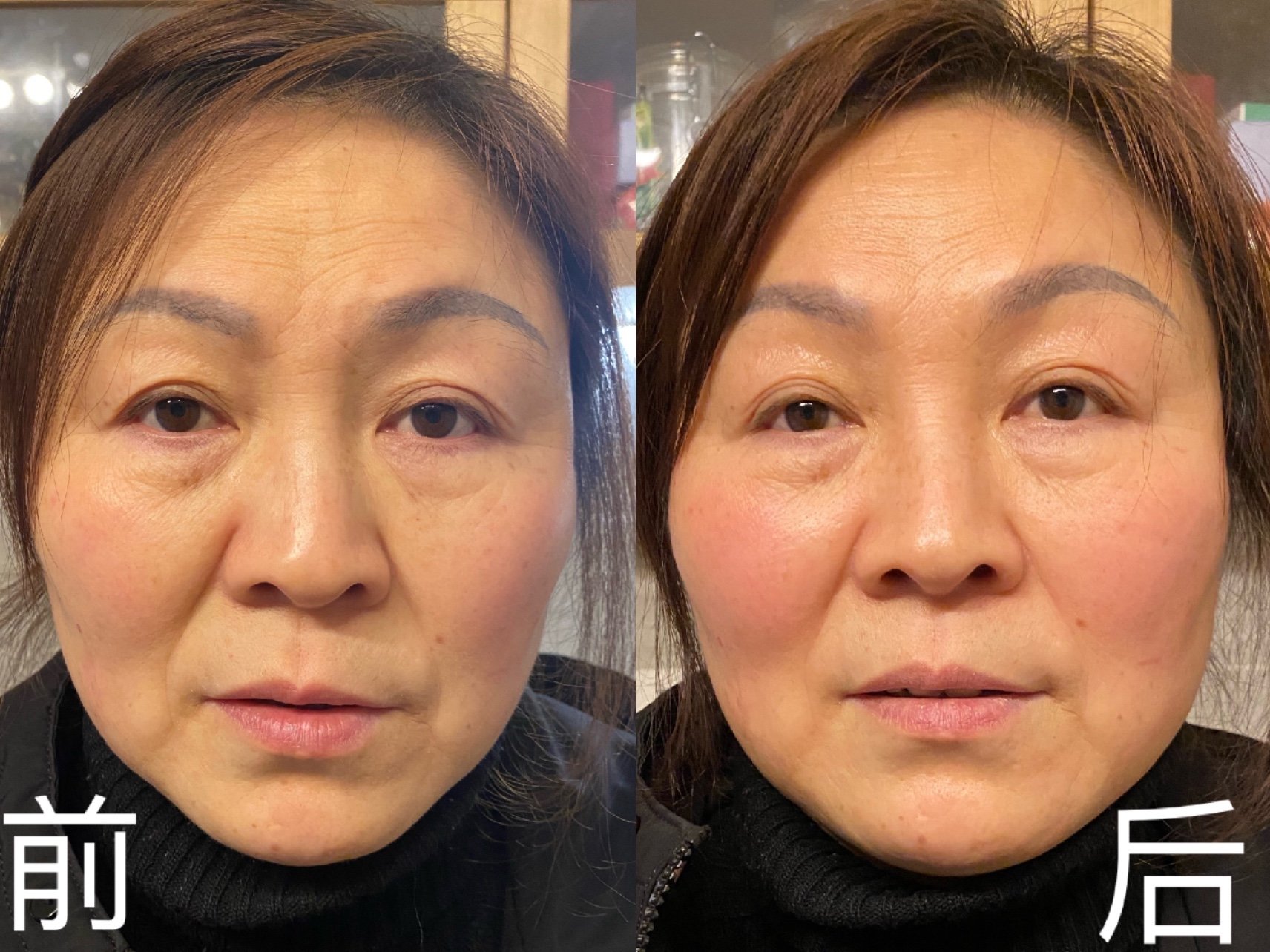 热拉提做肚子有什么功效(热拉提做肚子有什么功效与作用)