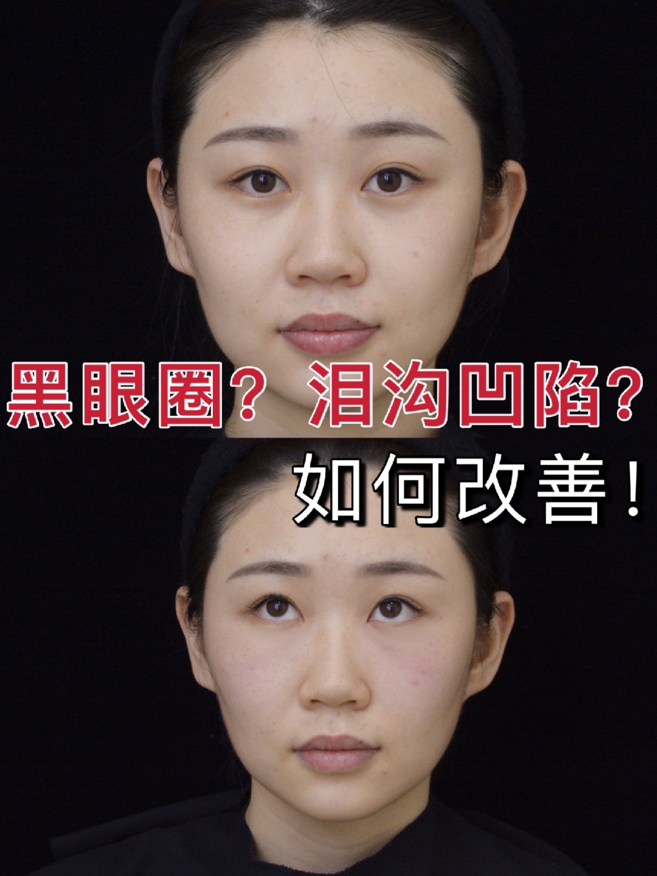 黑眼圈?泪沟凹陷?如何才能改善!