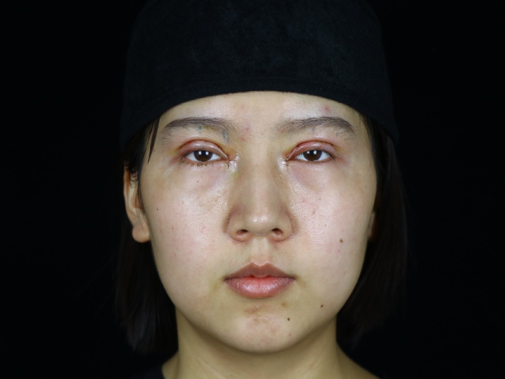 今天是我做完双眼皮手术的第一天,妈妈说可以和大家分_圈子-新氧美容